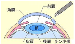 白内障手術の流れ1