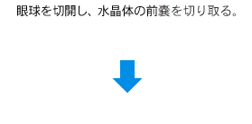 白内障手術の流れ2