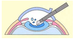 白内障手術の流れ3