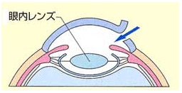 白内障手術の流れ5