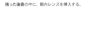 白内障手術の流れ6